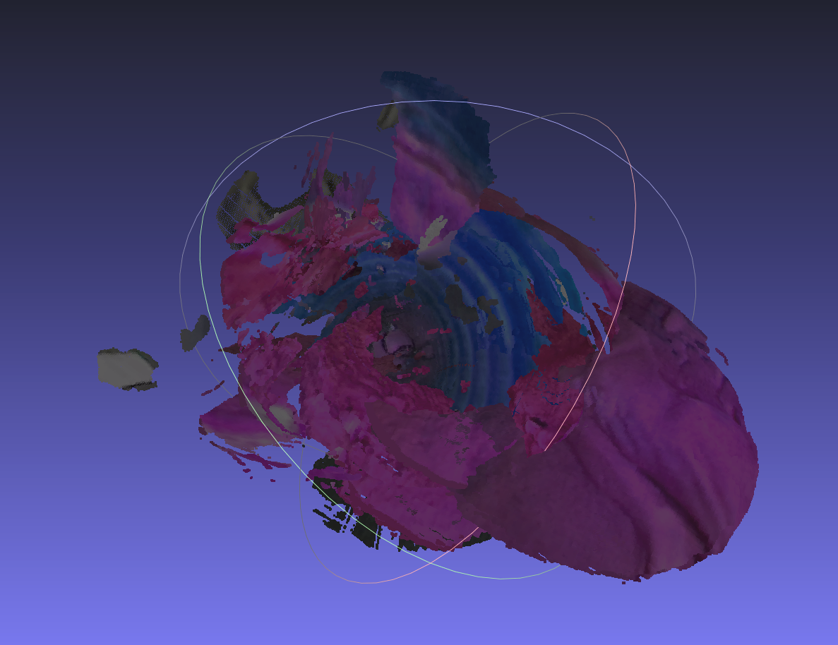 3D kidney reconstruction from CT scan