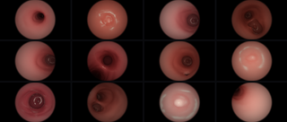 Realistic endoscope views rendered across twelve sampled anatomies by the procedural simulator.